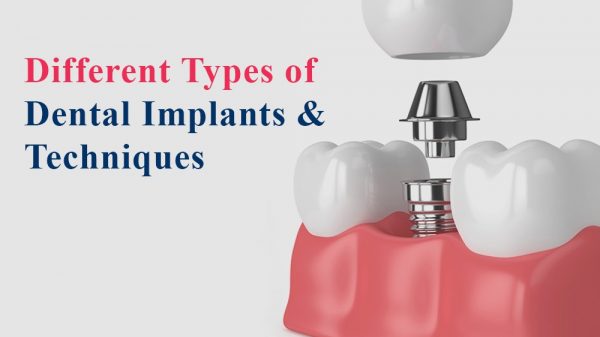 Dental Implants Types of Implants