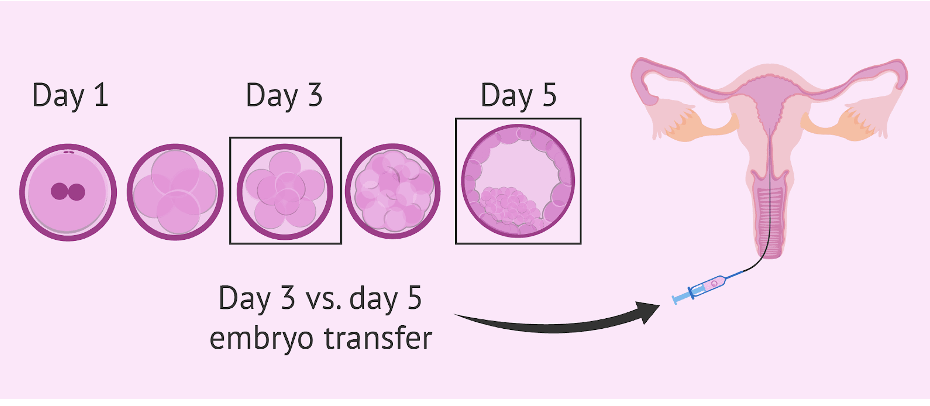 Embryo Transfer- All You Need To Know