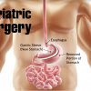 Types of Bariatric Surgery in Mumbai That Are Currently In Use