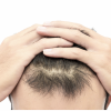What Are the Best and Most Effective Solutions for Male Hair Loss?