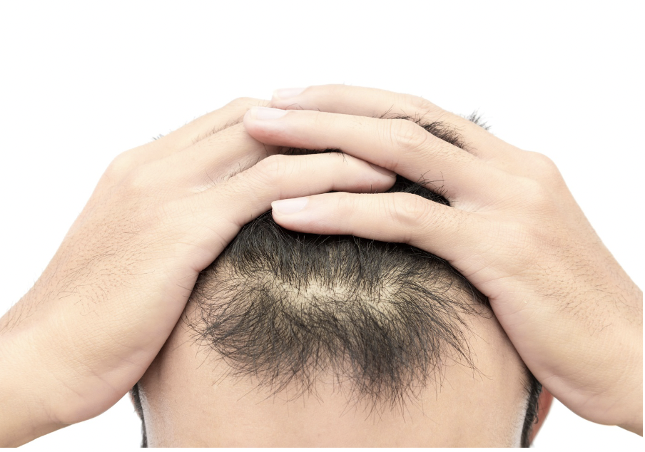 What Are the Best and Most Effective Solutions for Male Hair Loss?