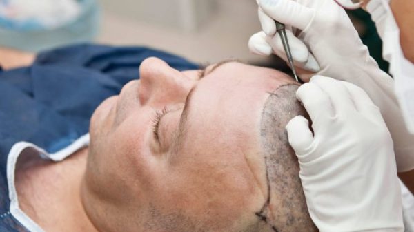 Everything You Need to Know About Hair Transplant