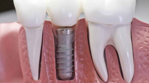 What Are the Types of Dental Veneers?