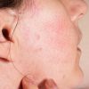 How To Identify and Manage Your Acne Rosacea Safely and Effectively