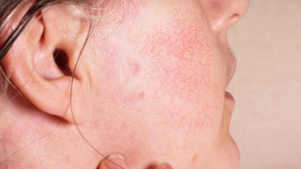 How To Identify and Manage Your Acne Rosacea Safely and Effectively