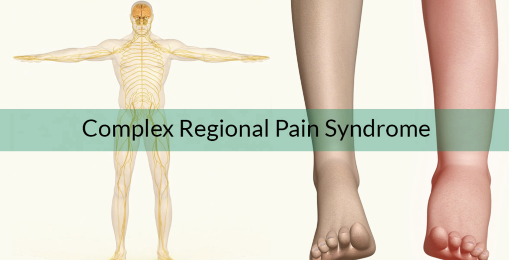 Understanding Complex Regional Pain Syndrome (CRPS) - Peak Mens Health