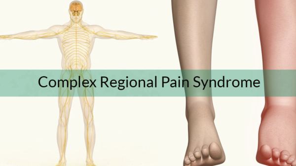 Understanding Complex Regional Pain Syndrome (CRPS)