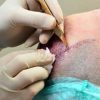 A Brief Introduction About Modern Hair Transplant