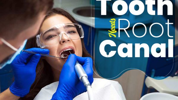 How-to-Know-if-Your-Tooth-Needs-Root-Canal