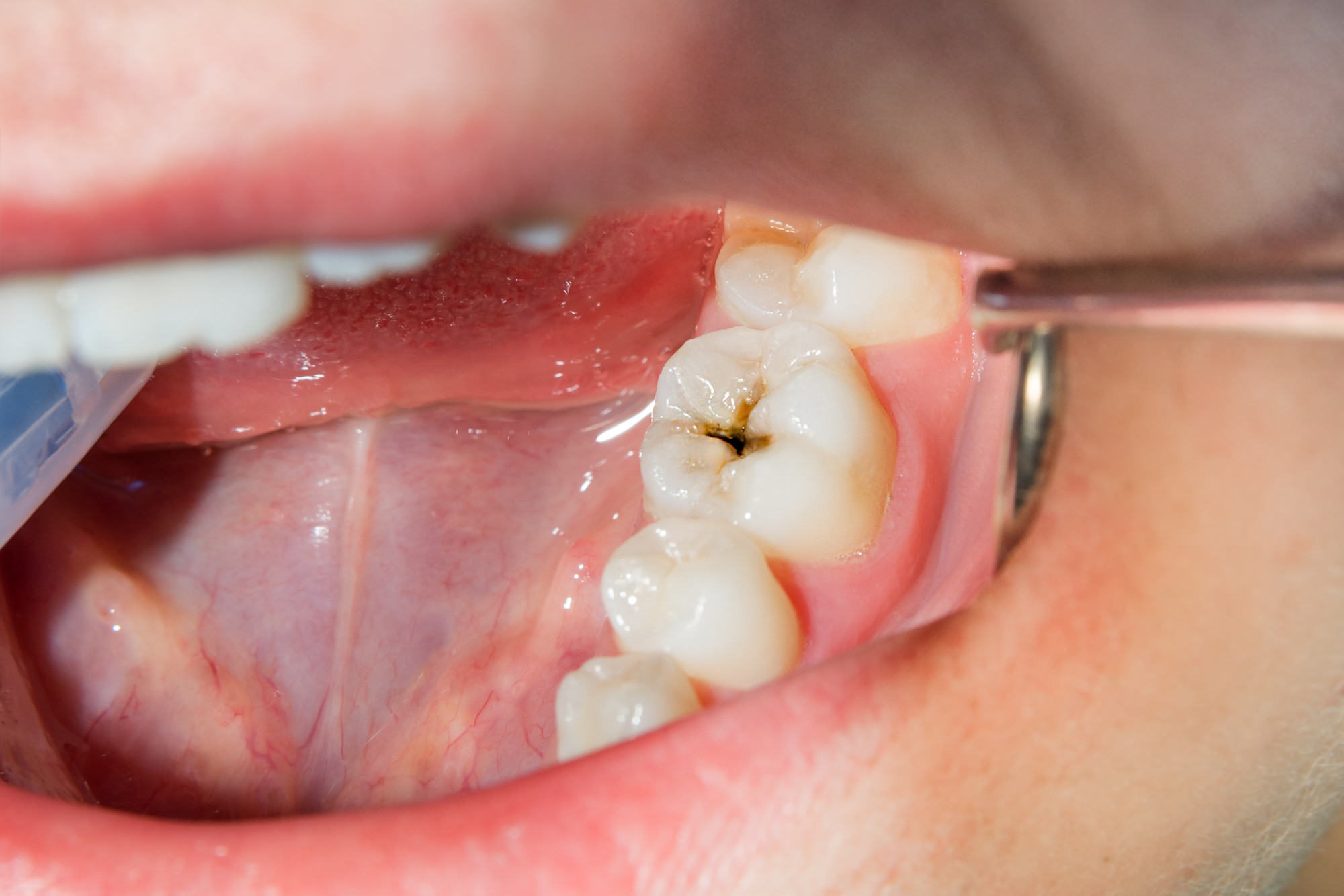 close-up of a human rotten carious tooth at the treatment stage in a dental clinic