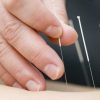 5 Surprising Benefits of Acupuncture for Fitness Enthusiasts