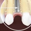 The Importance Of Dental Implants And Studies