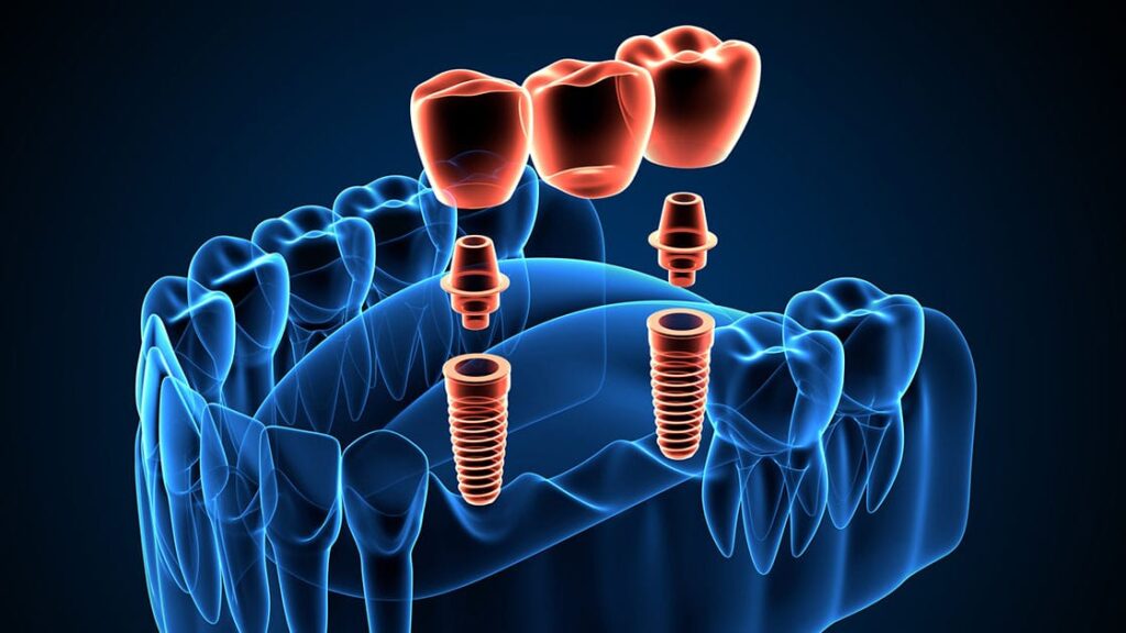The Future of Dental Implants: How 3D Printing is Revolutionising Oral Health