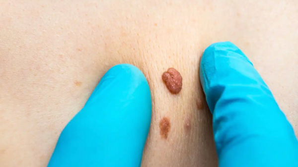 Remove Skin Tags Naturally ON Body Parts