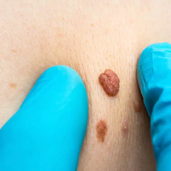 Remove Skin Tags Naturally ON Body Parts