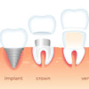 Implants Vs Crowns: What's The Difference?