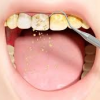 The Silent Threat: Understanding the Link Between Tartar and Gingivitis