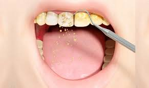 The Silent Threat: Understanding the Link Between Tartar and Gingivitis